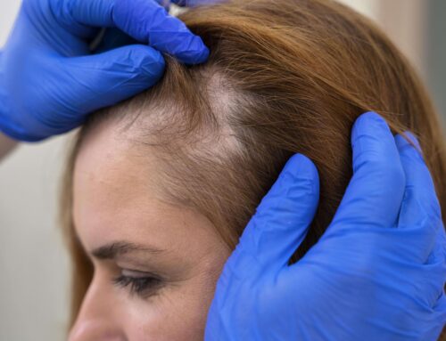 Claves para detectar la alopecia frontal