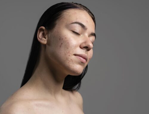 Acné hormonal en mujeres adultas: tratamiento dermatológico online