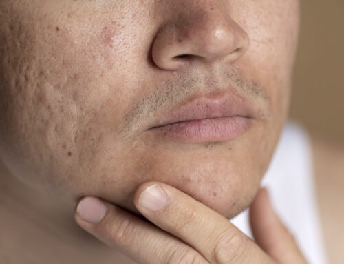 Acné adulto en invierno: causas hormonales y tratamiento dermatológico